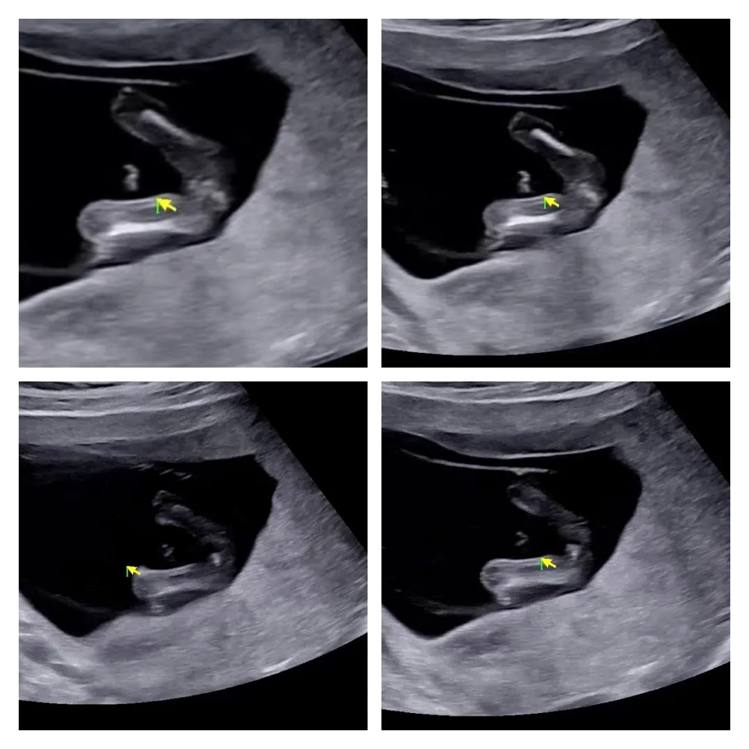 13주 2일, 끝이 갈라진걸까요?
