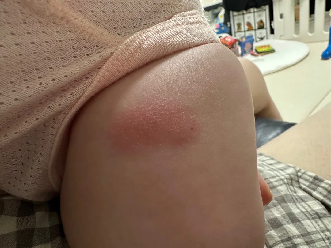 4개월 접종부위 부음