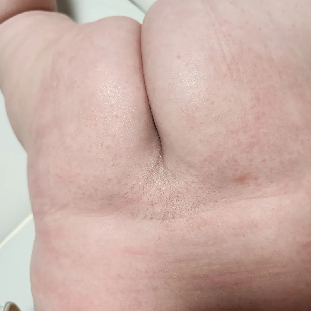 이거 땀띠인건가요?