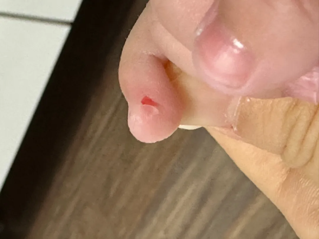 아기손가락 다쳤어요ㅠㅠ(사진첨부)