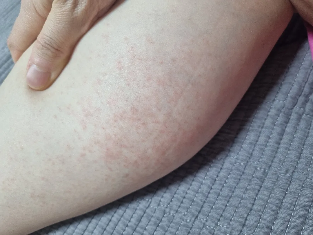 출산 후 소양증?