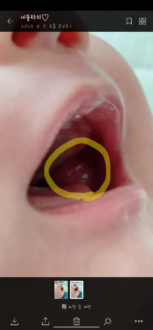 아기 입 안쪽 볼 부음증상, 저희애만 그런가요?