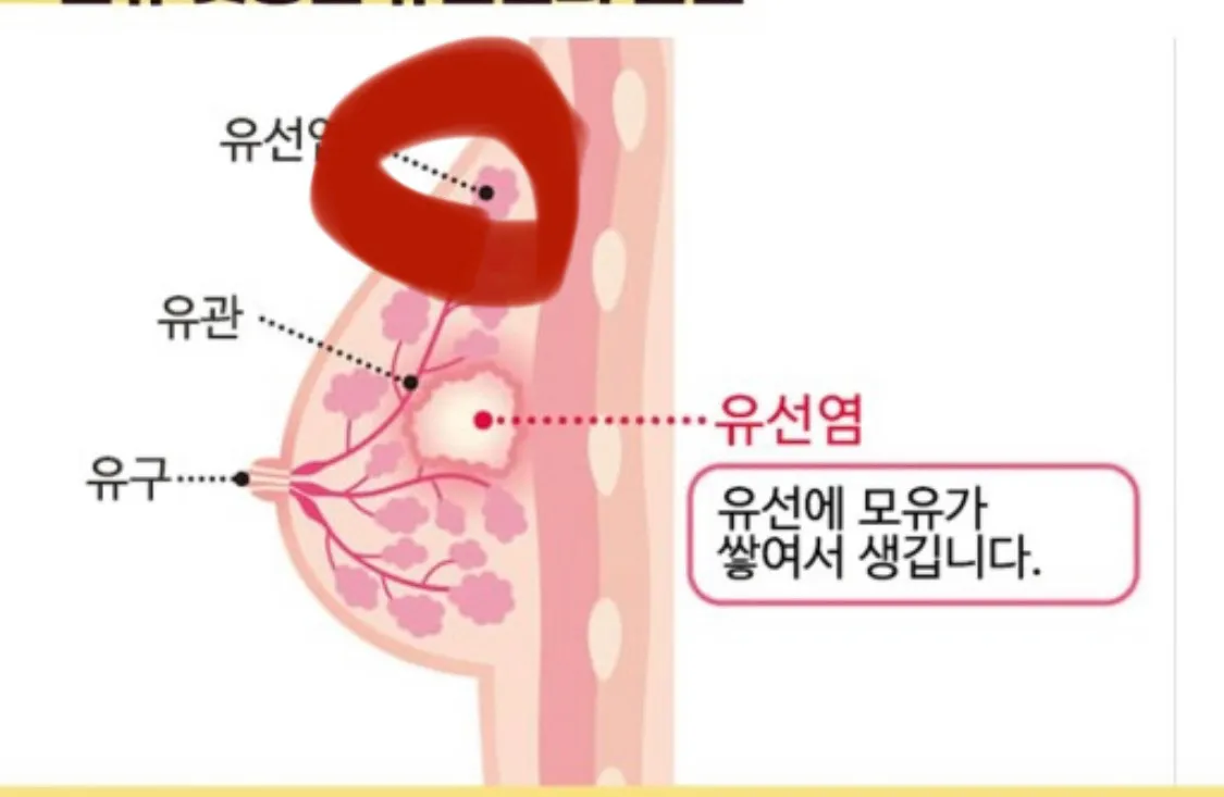 가슴 윗부분 멍울