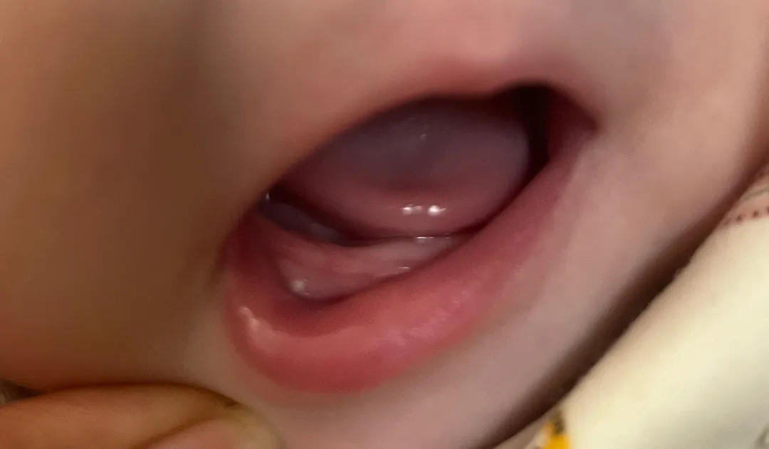 애기 잇몸에 뭐가 낫어요 ㅠ