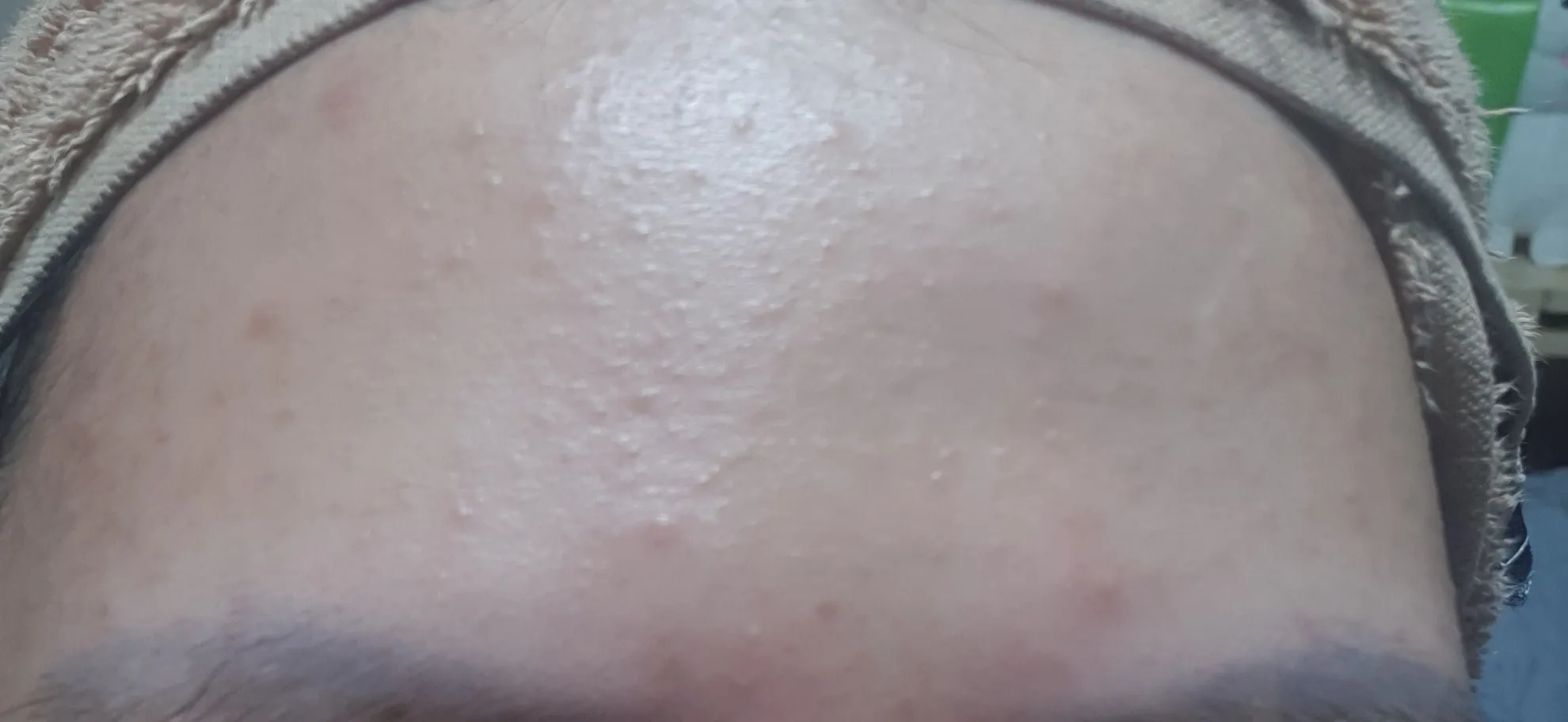 이마 트러블~~!ㅠ(사진약간혐오)