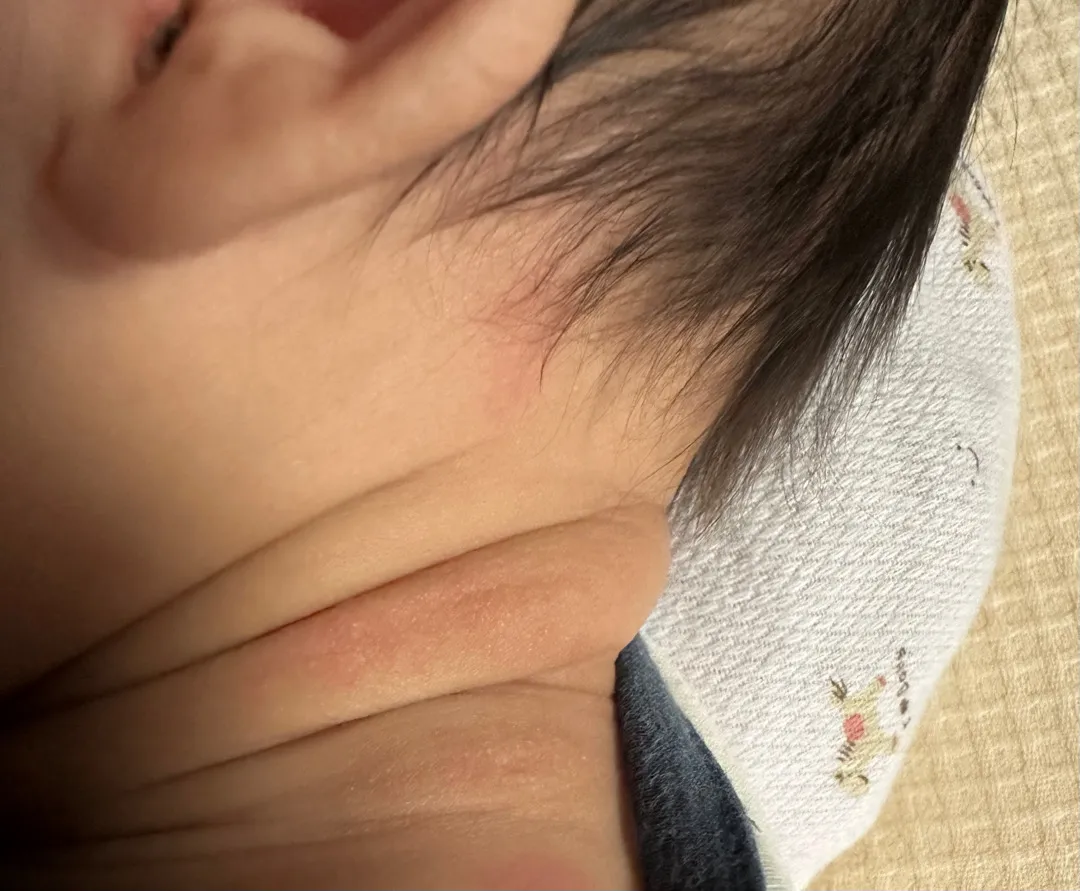 애기 목에 땀띠..?아토피..? 일까요ㅠㅠ 