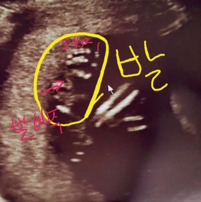 17주 영양제 질문