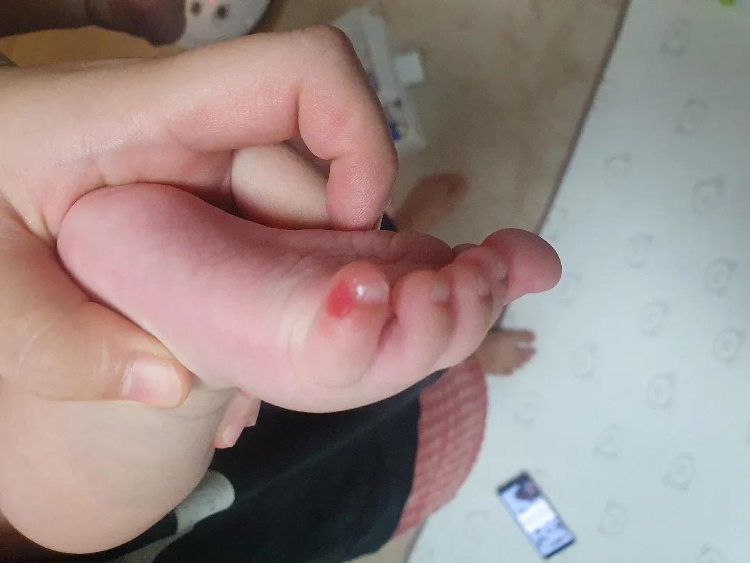 5개월 아이 상처에 뭐 붙이나요?
