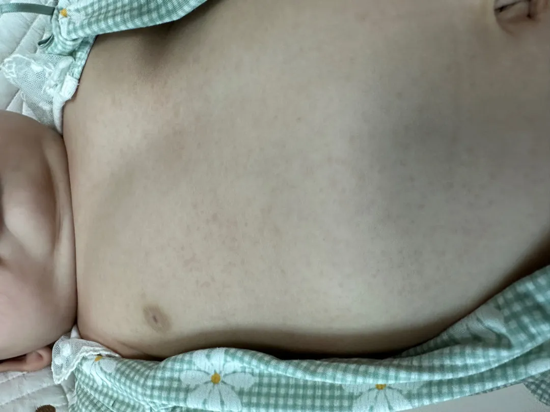 오트밀 알레르기 맞네여