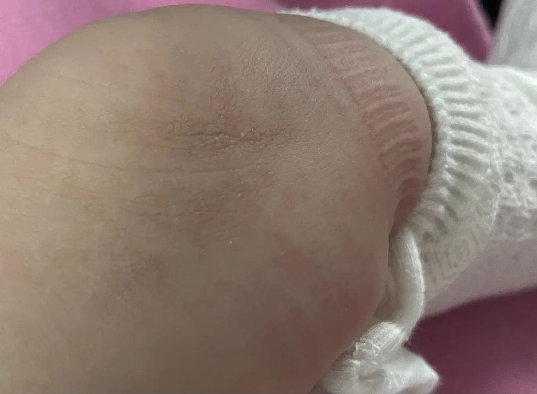 피부