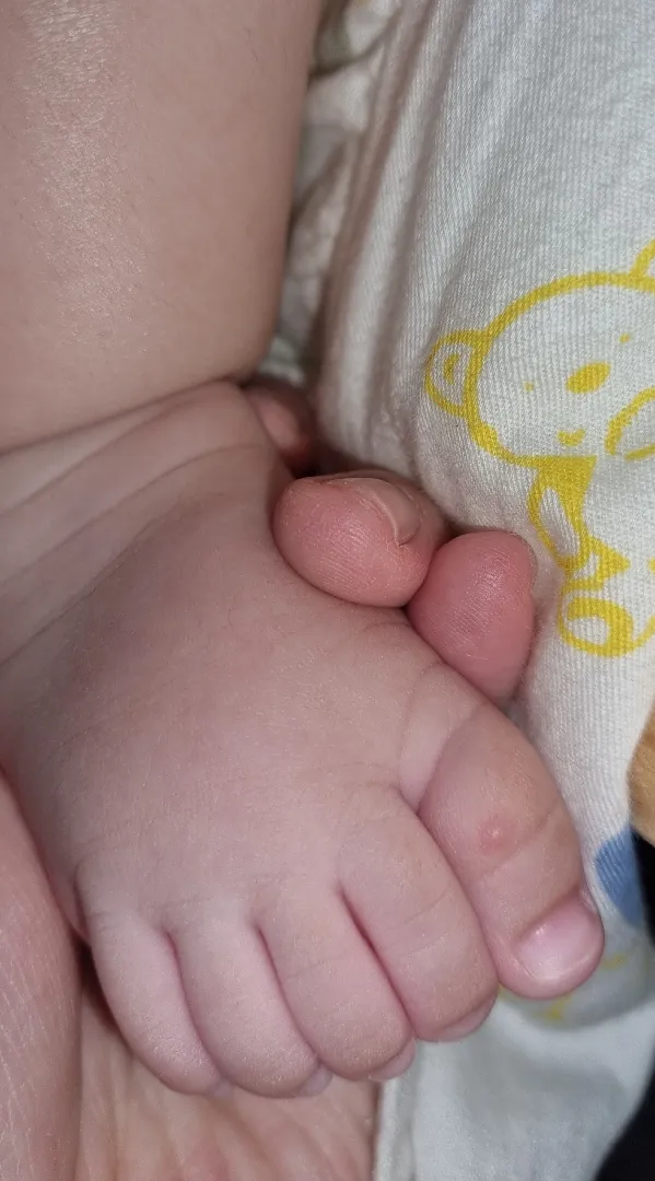 아기 볼, 발가락에 이게 뭘까요ㅠ