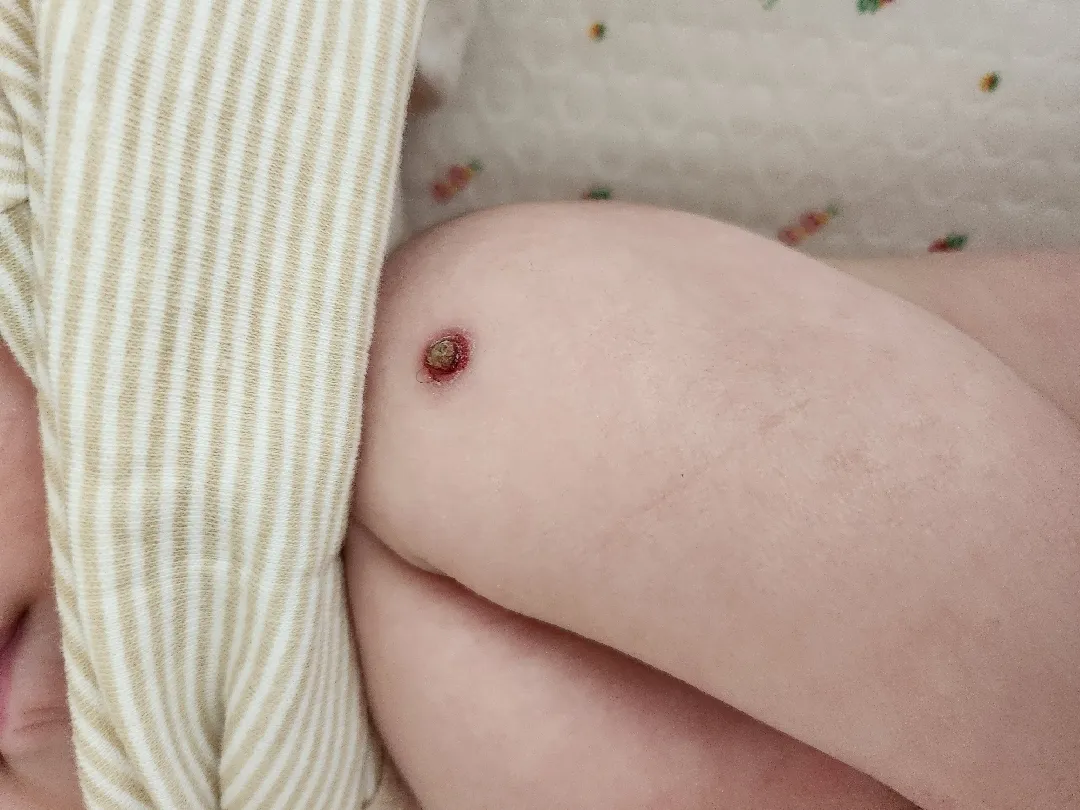 피내용 부작용..? 한번만 봐주세요ㅠㅠ