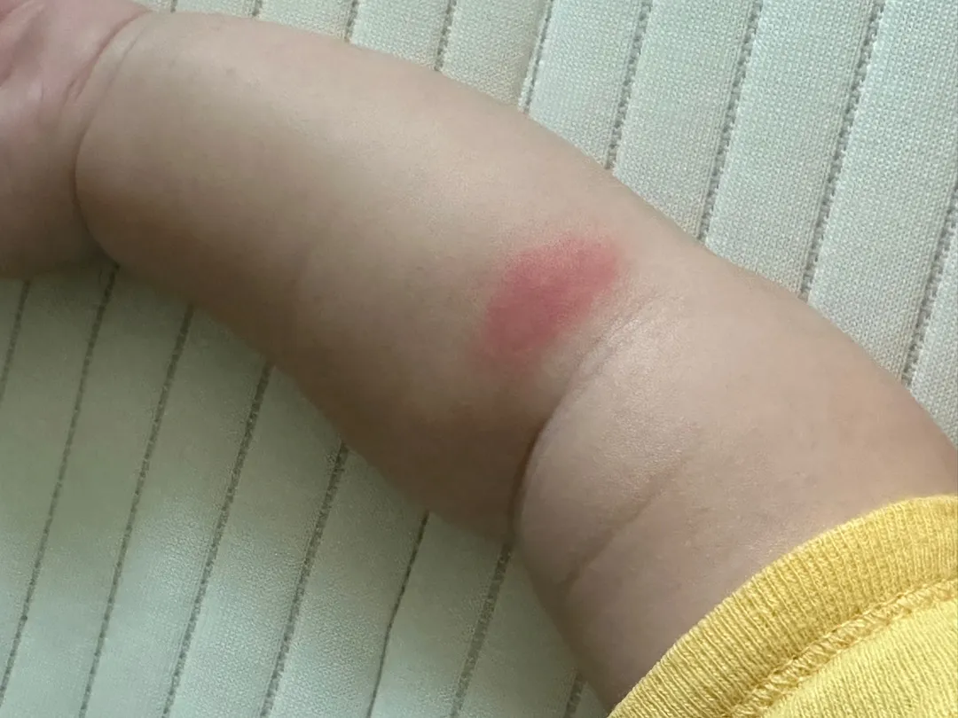 나쁜모기!!!ㅠㅠ