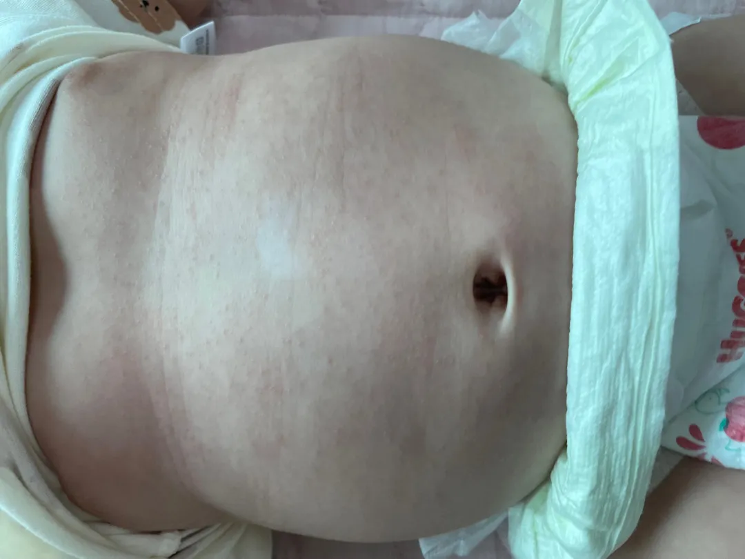 103일 아기 배 피부