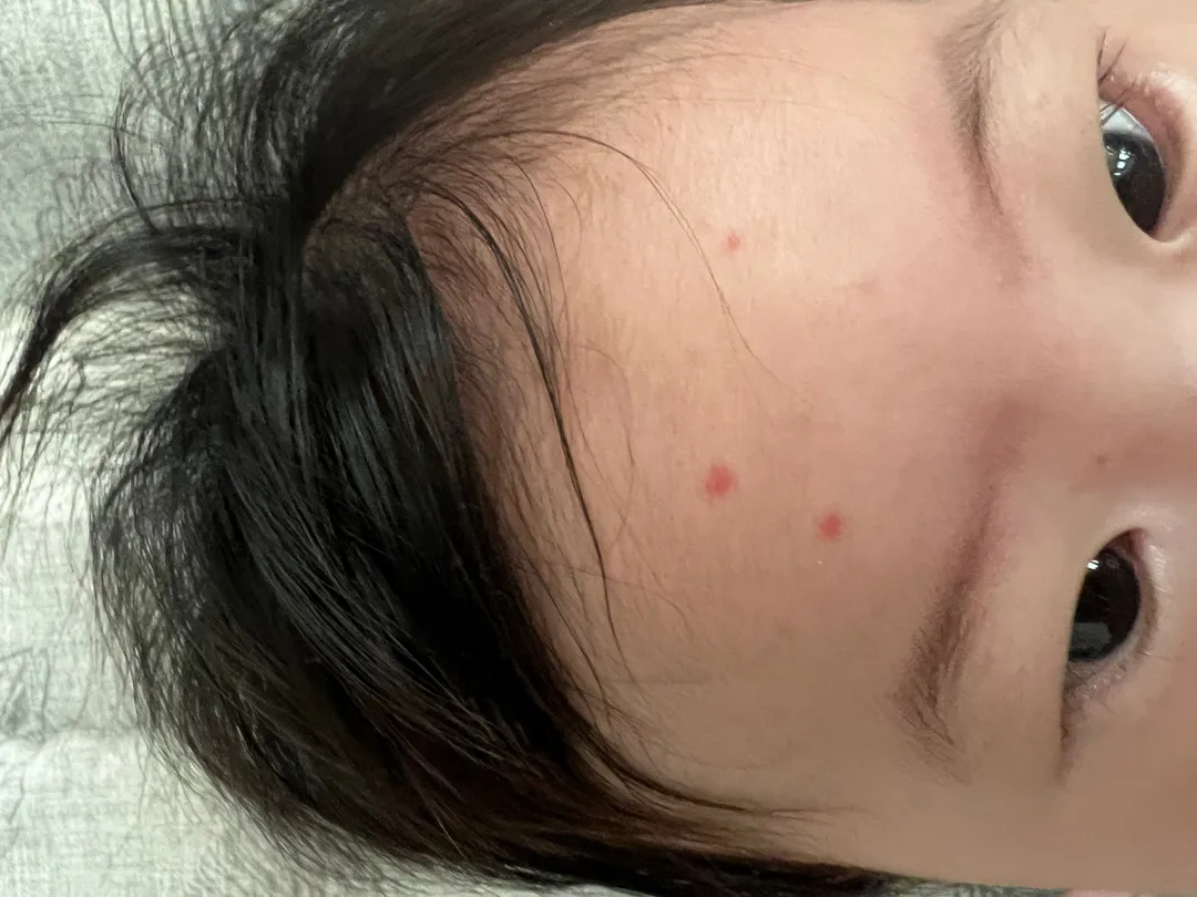 이게 땀띠 인지 벌레에 물린건지 아시는분 ㅠㅠ