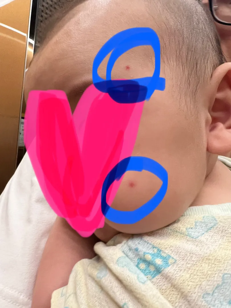 아기 뾰루지 좀 봐주세요..