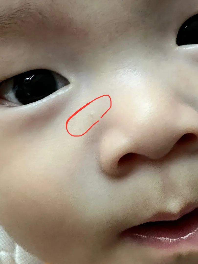 아기 얼굴에 이런게 있는데 뭘까요....?