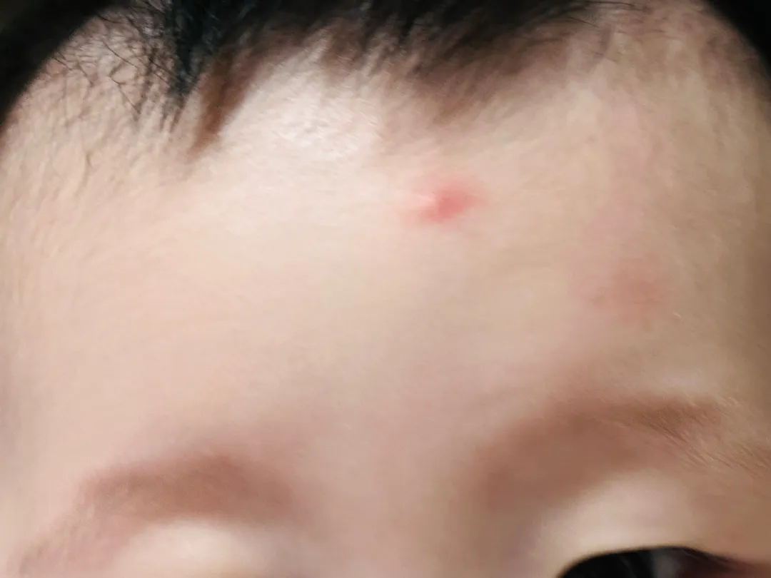 모기물리면 이런가요?? 