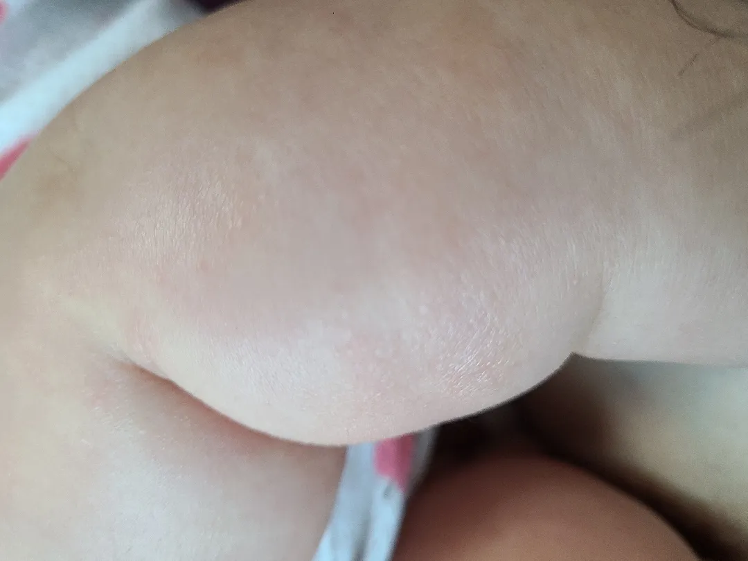 버짐인지 태열인지 이거 뭘까요?ㅠ