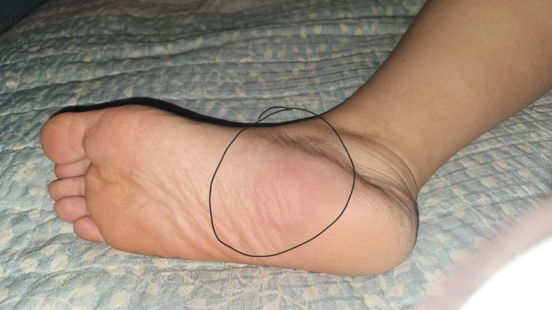 병원가봐야될까요?(발바닥사진?
