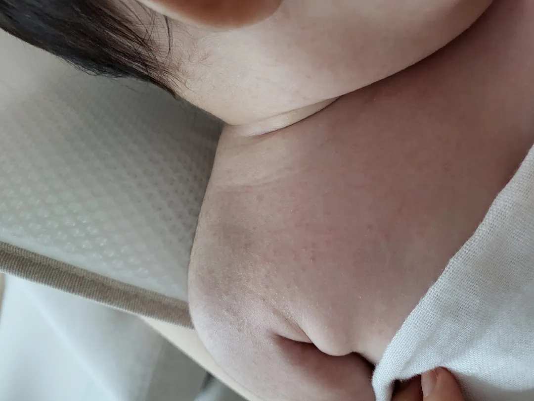 요거 땀띠인가요?ㅜㅜ