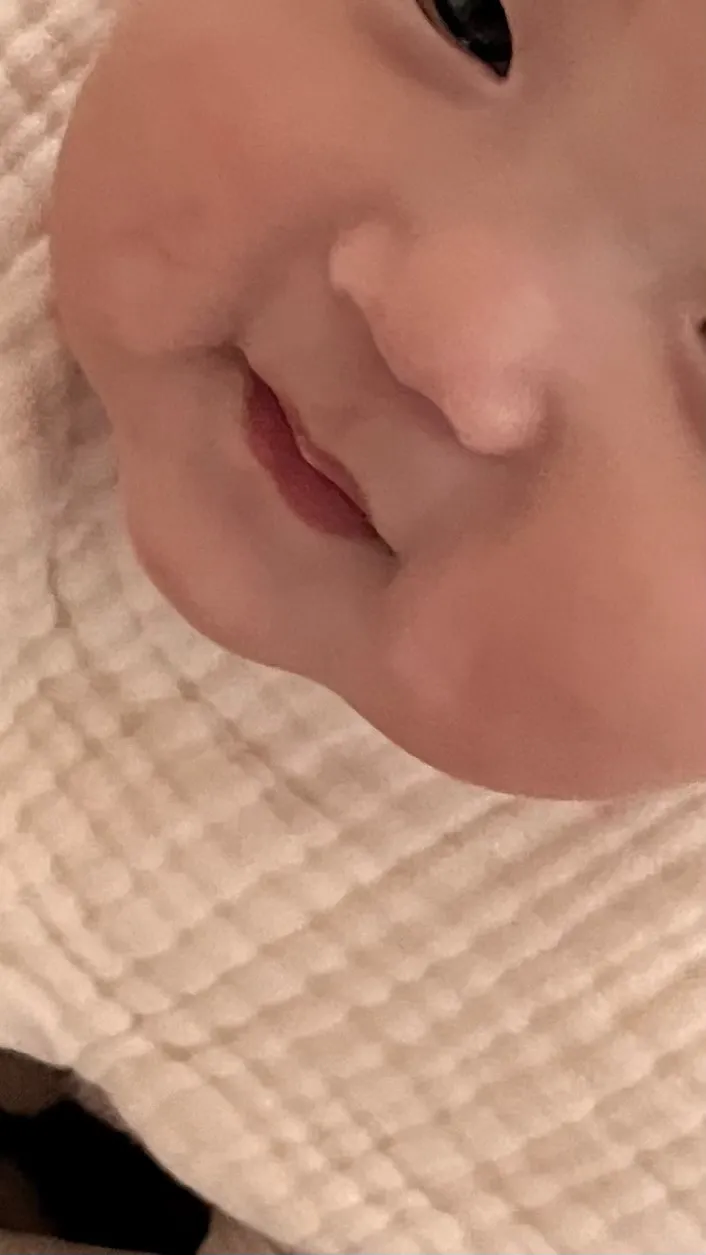 아기 침독 후 피부변색