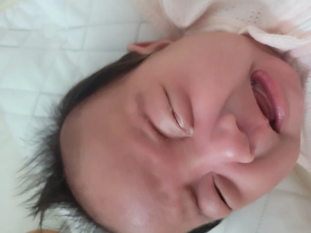 선천성 비루관폐색증 으로 진료받아보신분 계실까요?