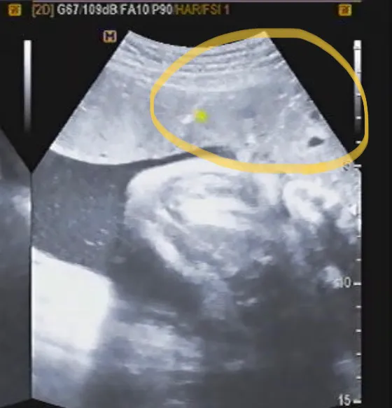 태반성숙 들어보신분 있으신가요??