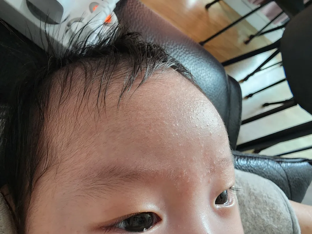 아가 이마에 뭐가 났어요~