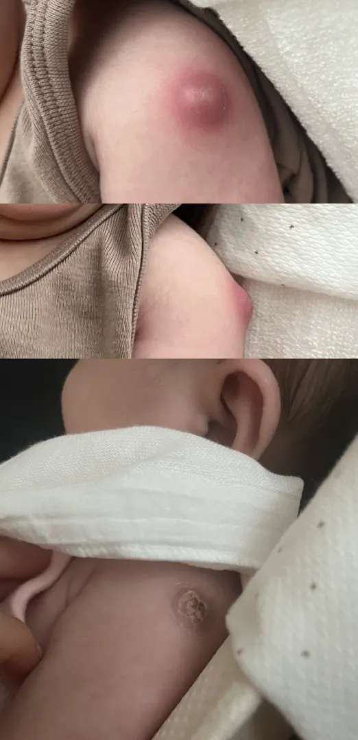 피내용 고름 봐주세요!