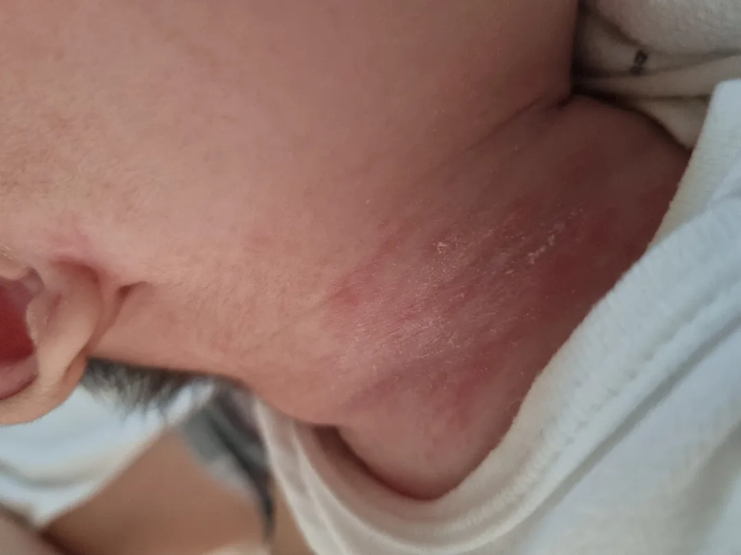 아기 피부 좀 봐주세요