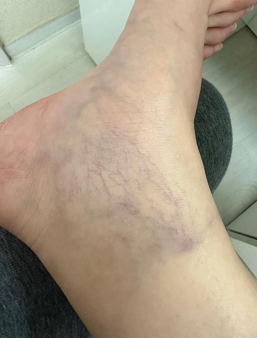 저처럼 다리에 이런거 생기신분 ㅠㅠ 