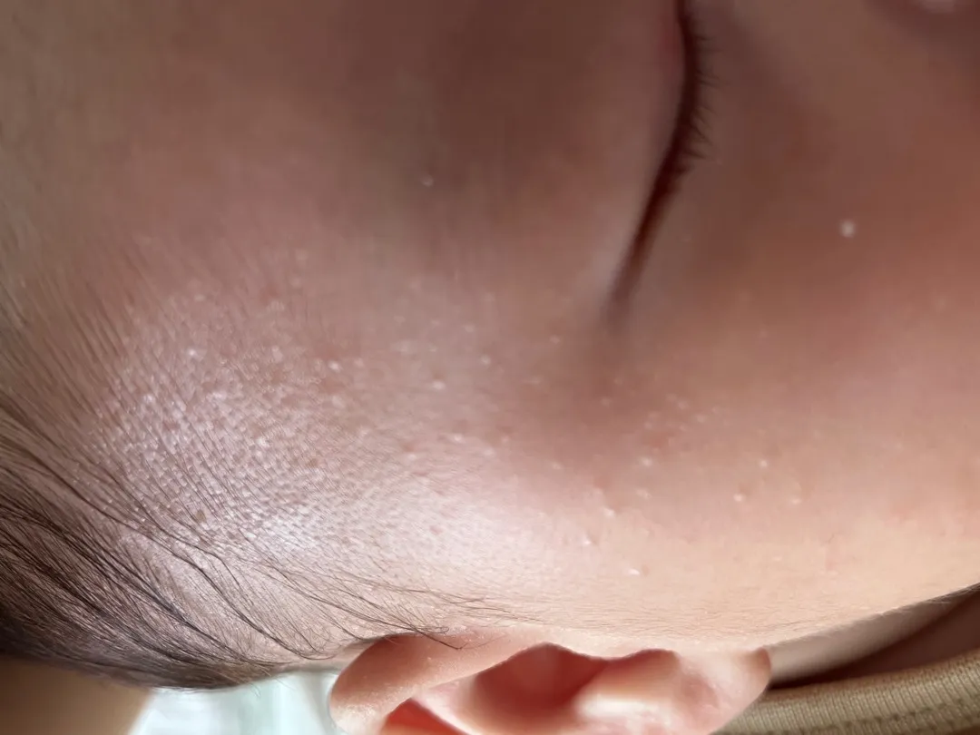 힙분유 좁쌀여드름 ㅠㅠ