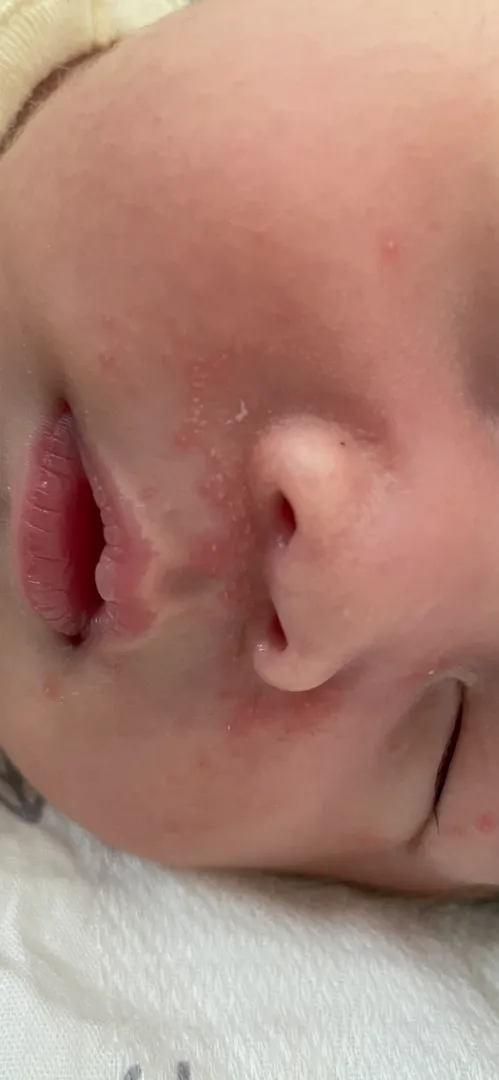 태열때문에 미치게써요ㅠㅠ