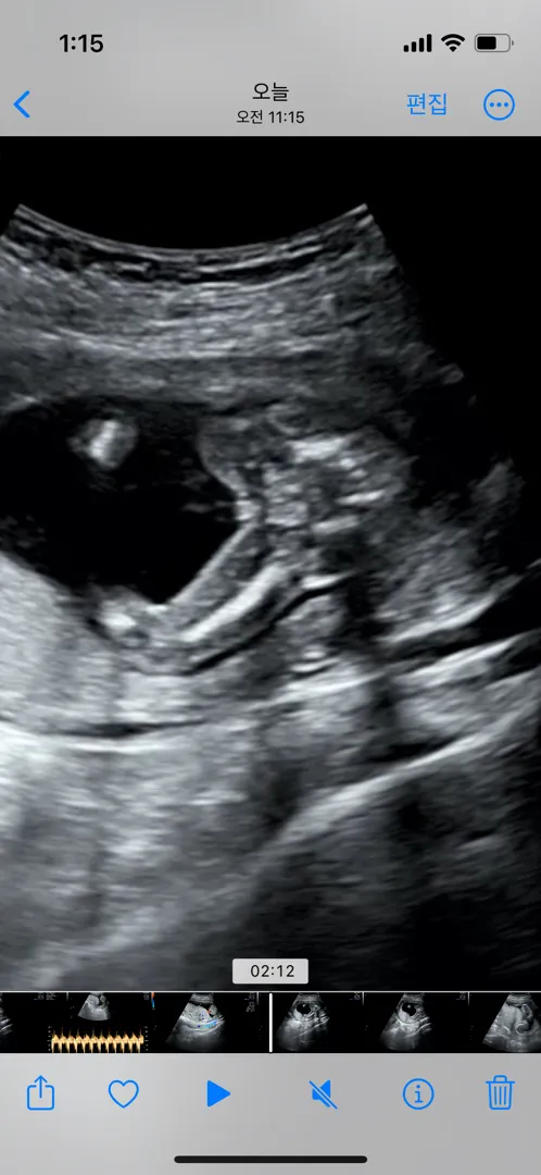 15주6일차 초음파보고왔는데 성별을 안알려 주시네요 고수님들 부탁드립니다 