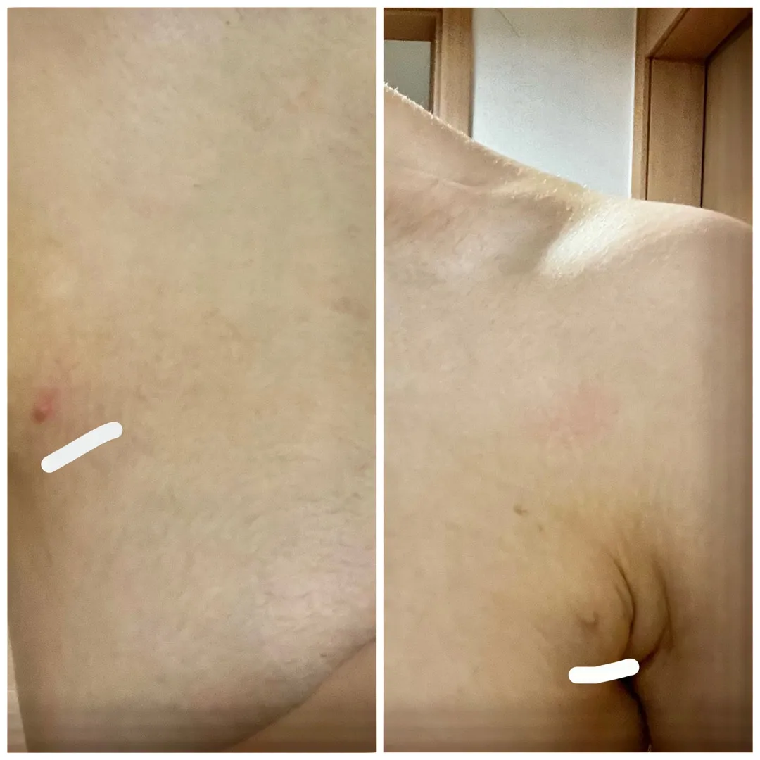 혹시가슴옆에 뾰루지 (사진쫌^^..죄송요)