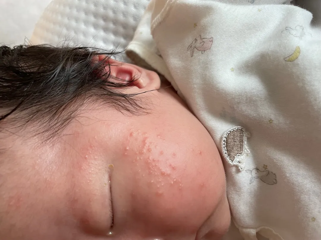 31일차 남아 얼굴 땜에 속상해요ㅠㅠ