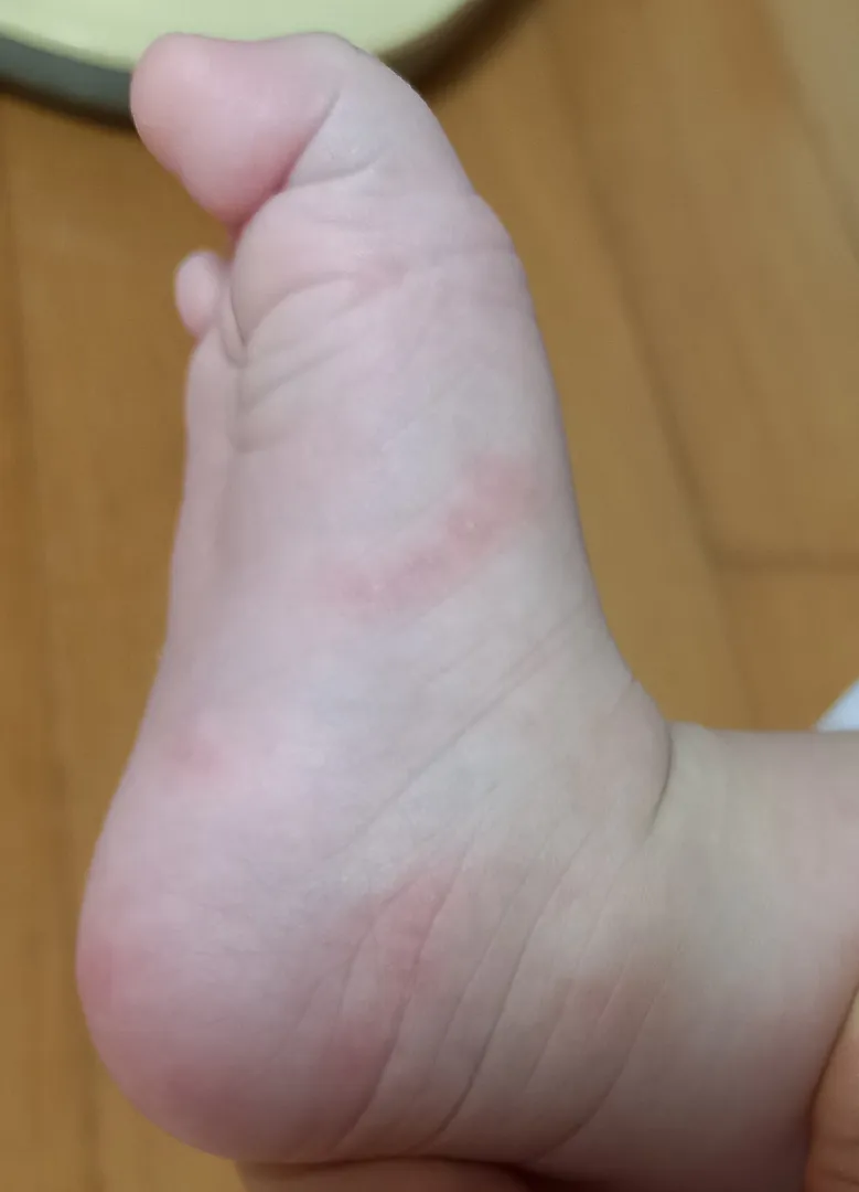 잘안먹는아기 발에 오돌토돌