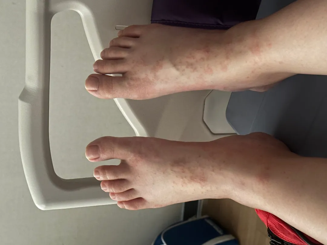 양수터져서 37주 5일에 제왕절개 출산 후 알레르기사진첨부(혐오주의)