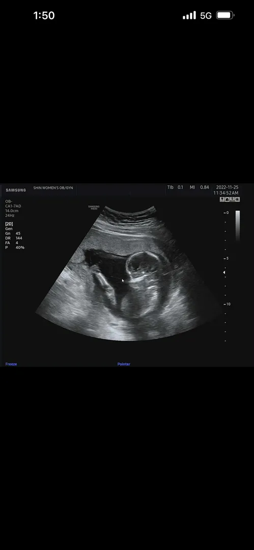 16주3일 2차 기형아 검사