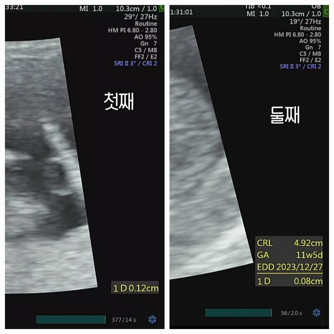 11w 5d 아가들 보고 왔어요 :)🫶🏻