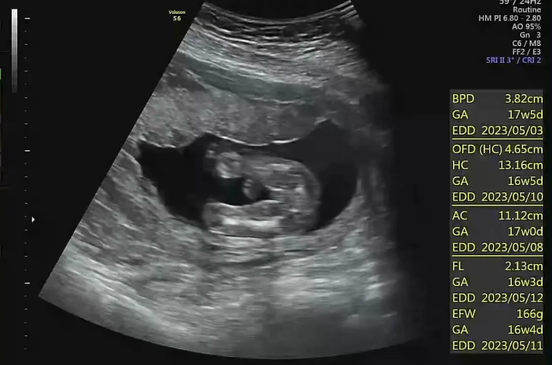 16주3일 성별 + 정밀초음파검사 
