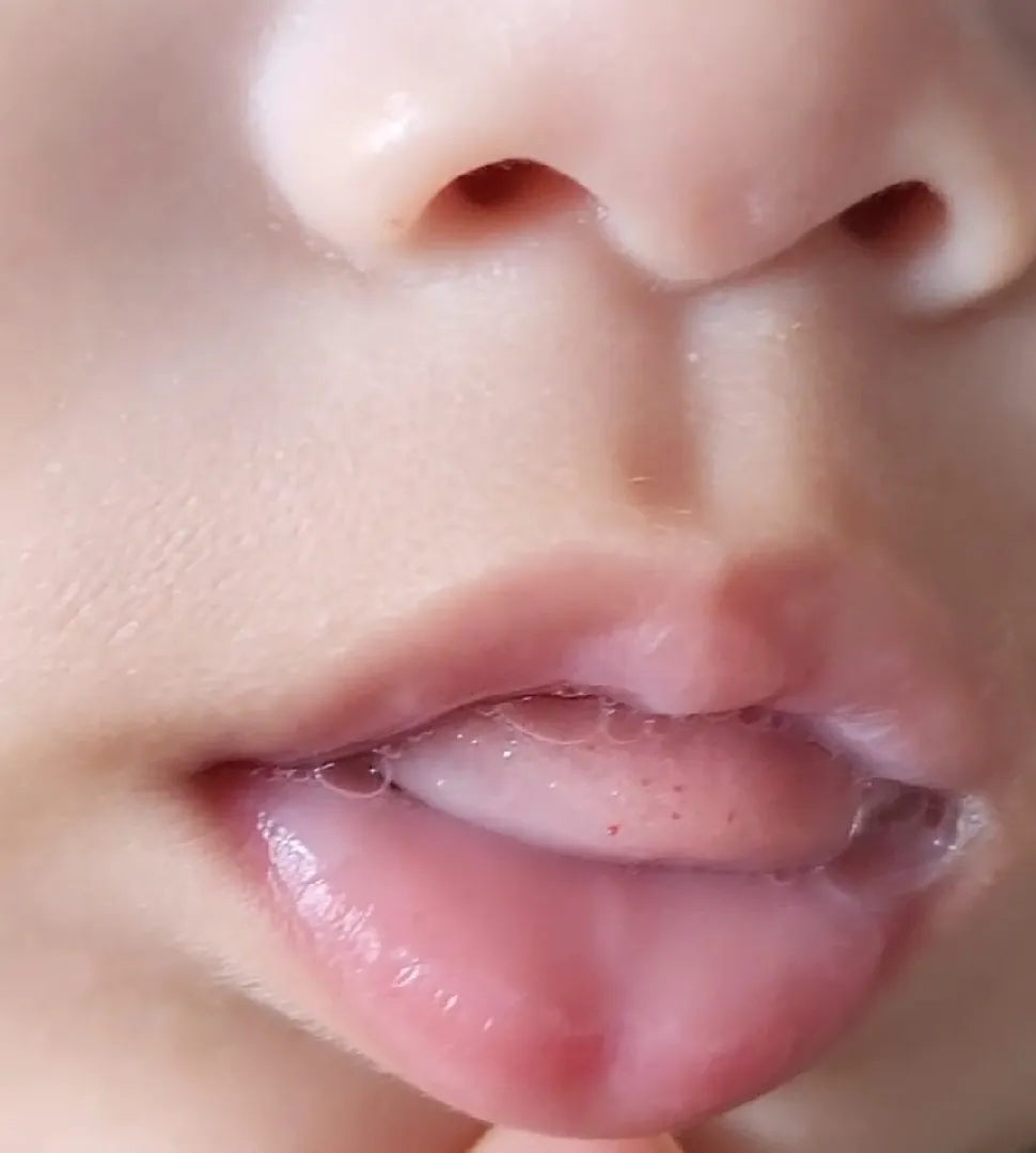 아기 혀끝 빨간점?