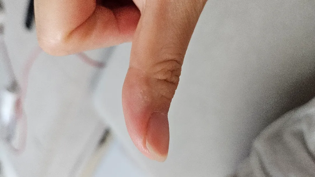 이거뭘까요??주부습진일까요??