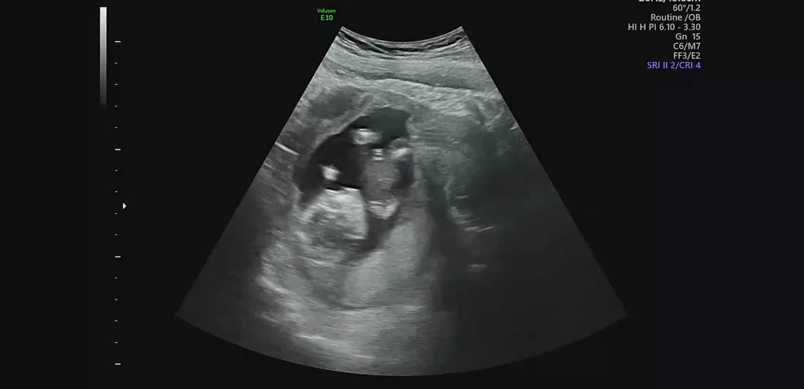 저처럼 가로줄3개는 아들인가요 딸인가요? 