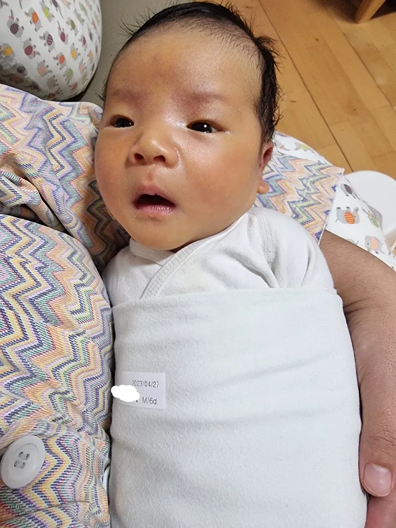 신생아 황달