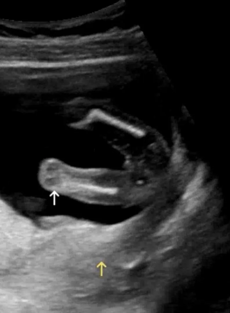 16주 1일차 아가 보고 왔어요! 성별이 예상이 맞는거겠죠?