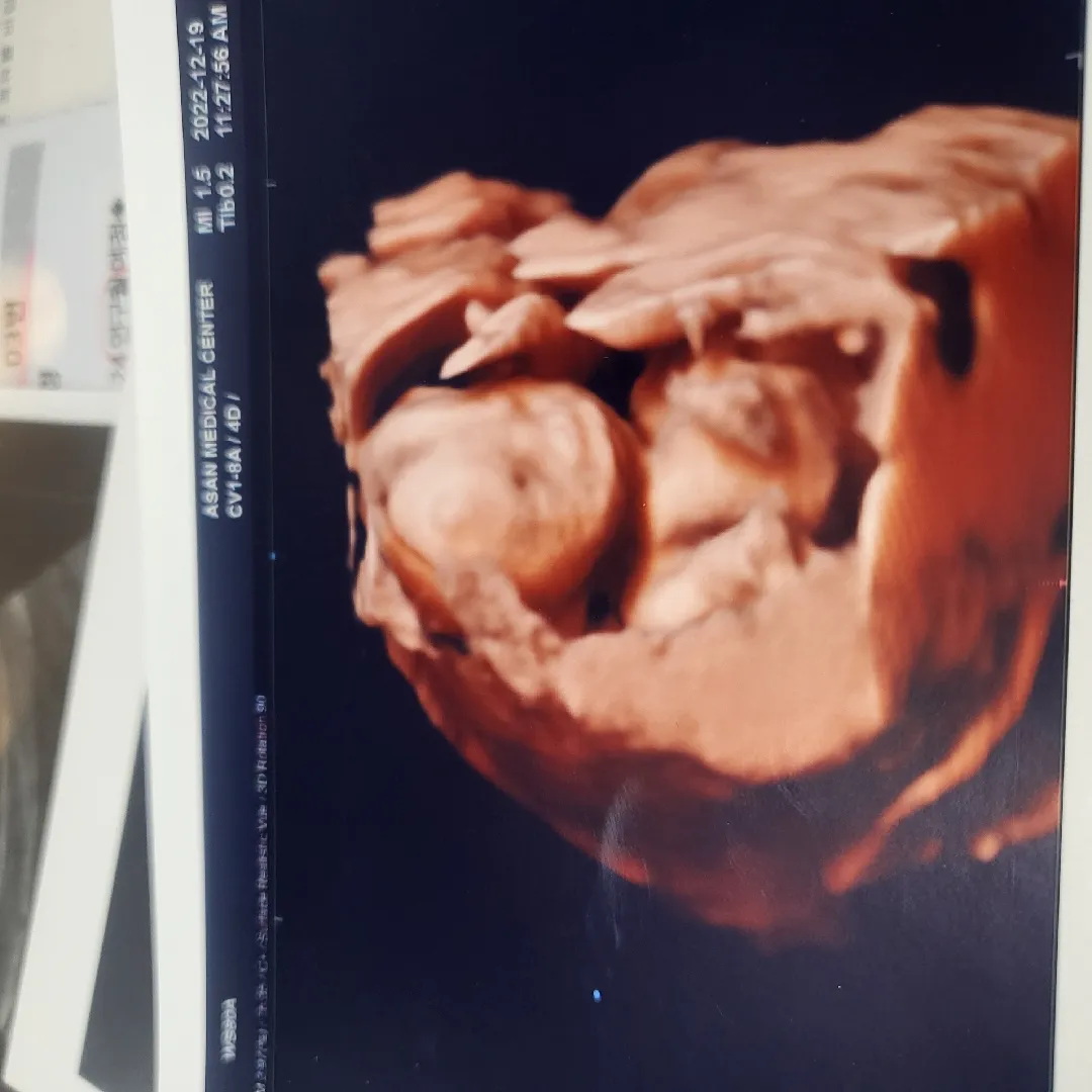 19주 3일 입체초음파 자랑하고 싶어요 ㅎㅎㅎㅎ