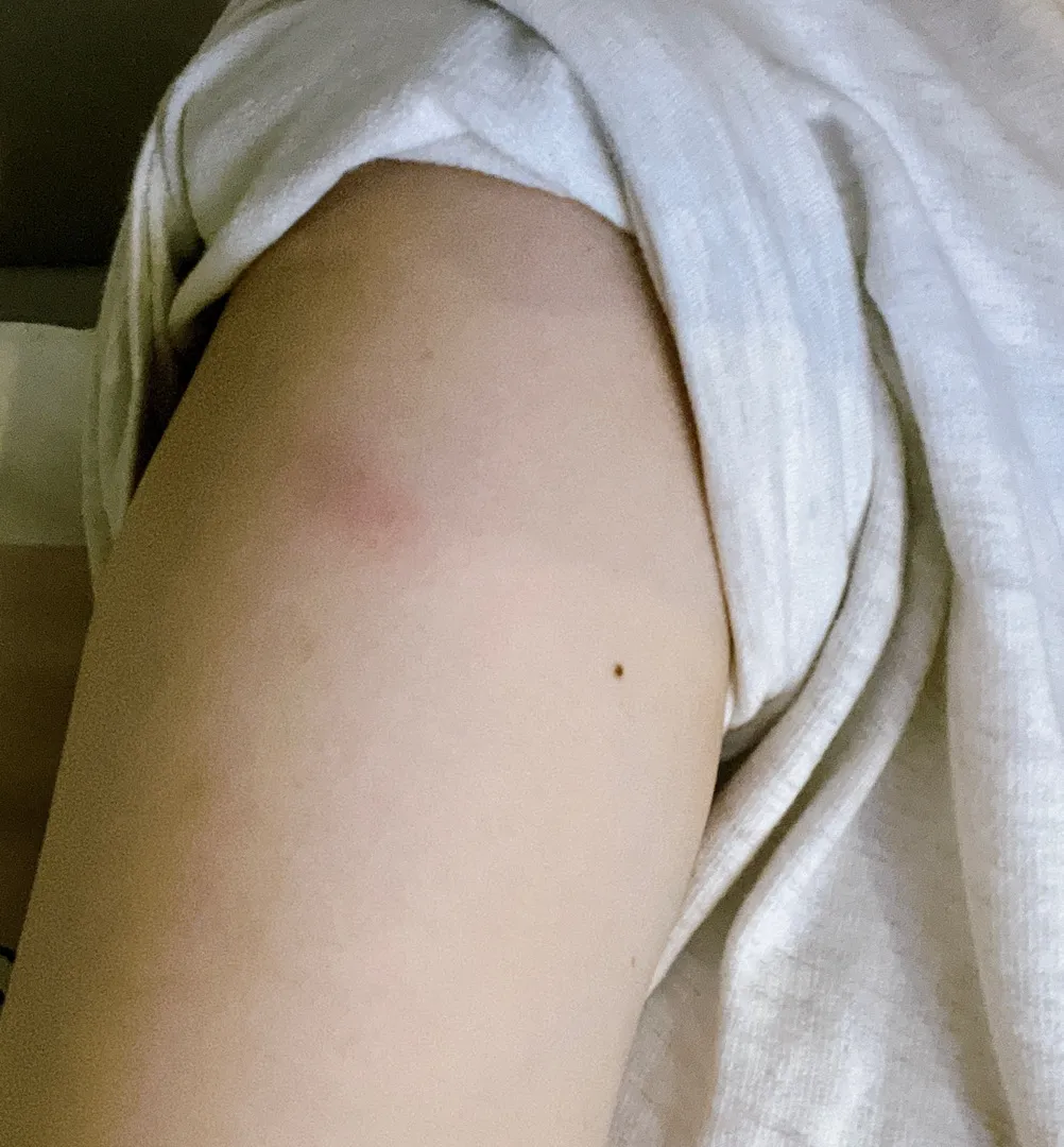 백일해 주사 후