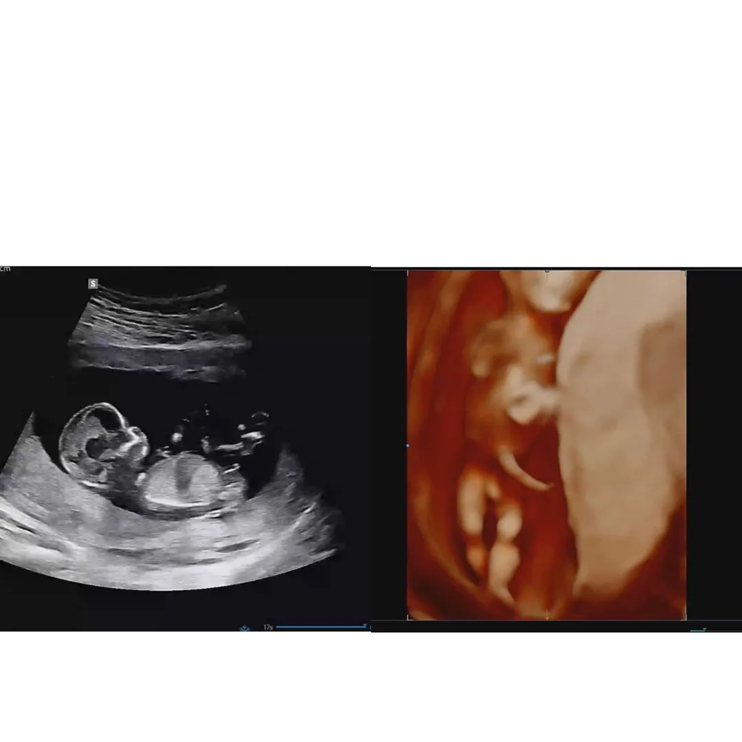 12주 3일 1차기형아검사 했네욤 아들일까욤👶🏻